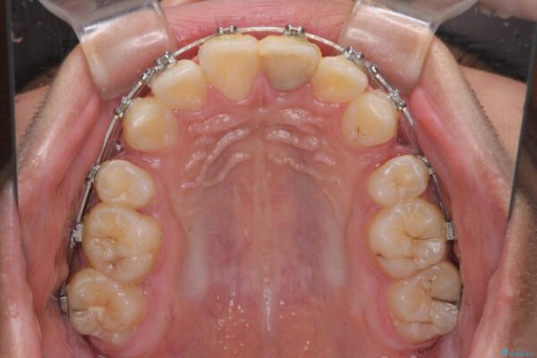 膨らんだ口元　ワイヤー装置での抜歯矯正 治療途中画像