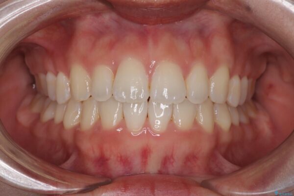 目立ちにくい表側装置で1年完了!狭いアーチを側方拡大し前歯のデコボコを整えた症例 治療後画像