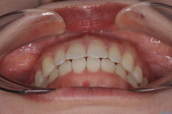 目立ちにくい表側装置で1年完了!狭いアーチを側方拡大し前歯のデコボコを整えた症例 治療後画像