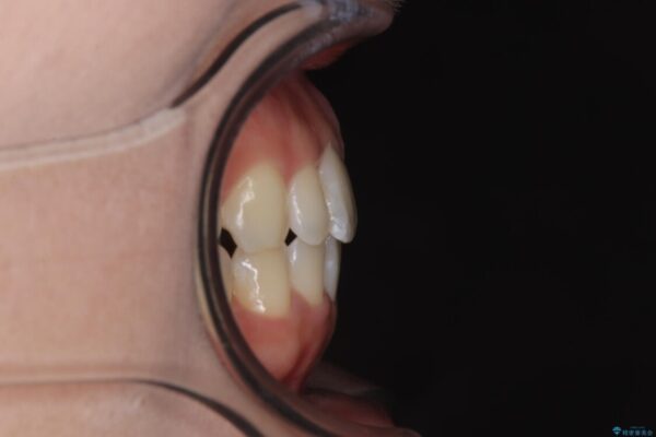 目立ちにくい表側装置で1年完了!狭いアーチを側方拡大し前歯のデコボコを整えた症例 アフター