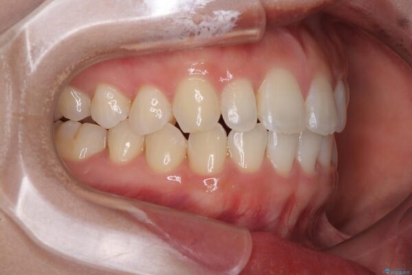 目立ちにくい表側装置で1年完了!狭いアーチを側方拡大し前歯のデコボコを整えた症例 治療後画像