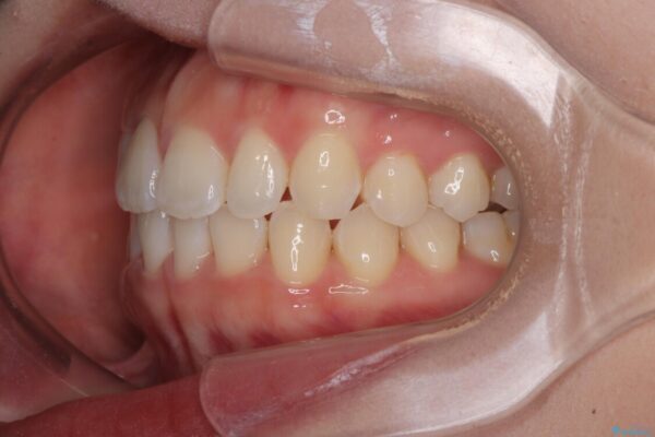 目立ちにくい表側装置で1年完了!狭いアーチを側方拡大し前歯のデコボコを整えた症例 治療後画像