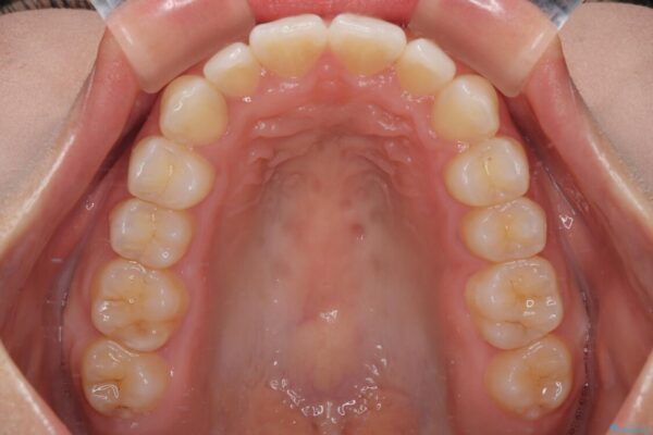 目立ちにくい表側装置で1年完了!狭いアーチを側方拡大し前歯のデコボコを整えた症例 治療後画像