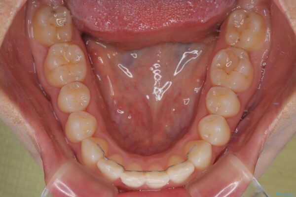 目立ちにくい表側装置で1年完了!狭いアーチを側方拡大し前歯のデコボコを整えた症例 治療後画像