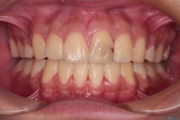 膨らんだ口元　ワイヤー装置での抜歯矯正 治療後画像