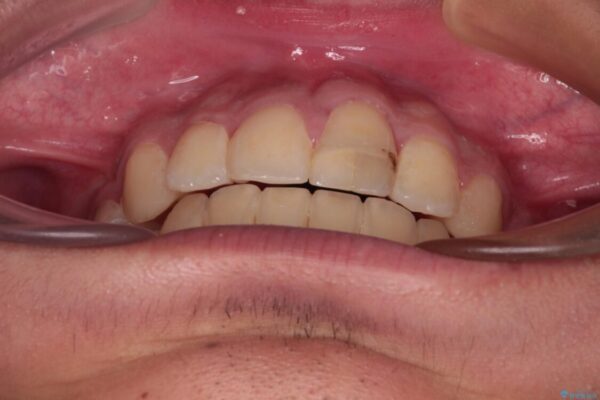 膨らんだ口元　ワイヤー装置での抜歯矯正 治療途中画像