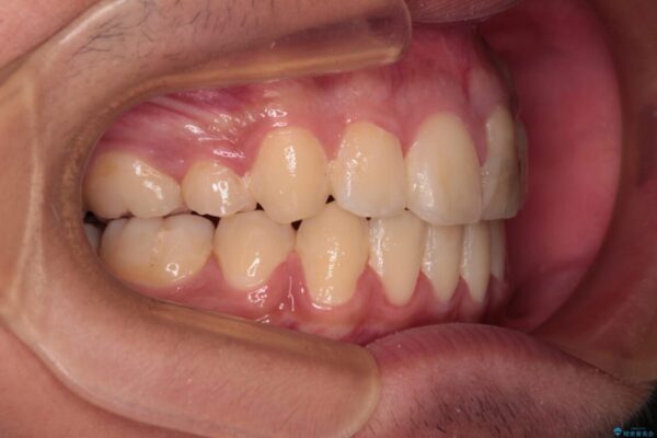 膨らんだ口元　ワイヤー装置での抜歯矯正 治療後画像