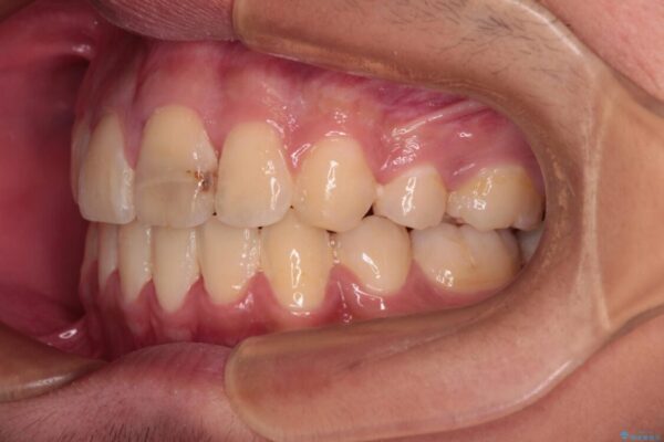 膨らんだ口元　ワイヤー装置での抜歯矯正 治療後画像