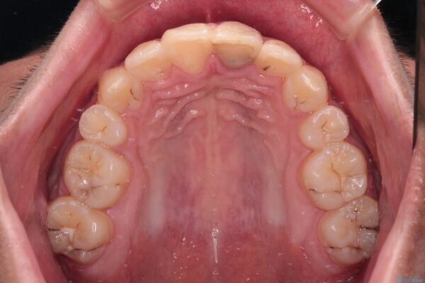 膨らんだ口元　ワイヤー装置での抜歯矯正 治療後画像