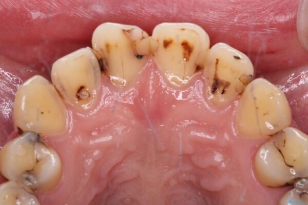 むし歯だらけの前歯をオールセラミッククラウンできれいに 治療前画像