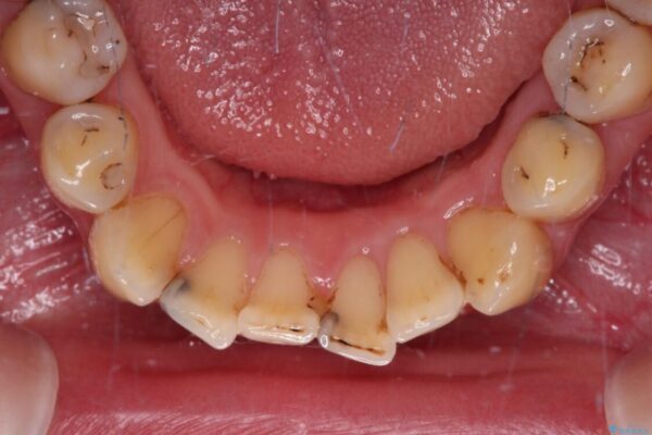 むし歯だらけの前歯をオールセラミッククラウンできれいに 治療前画像