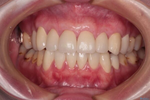 むし歯だらけの前歯をオールセラミッククラウンできれいに アフター