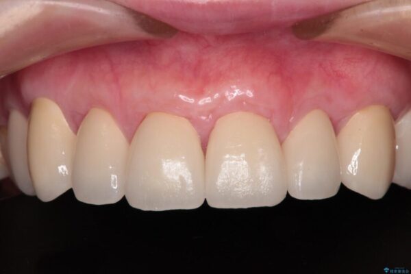 むし歯だらけの前歯をオールセラミッククラウンできれいに 治療後画像