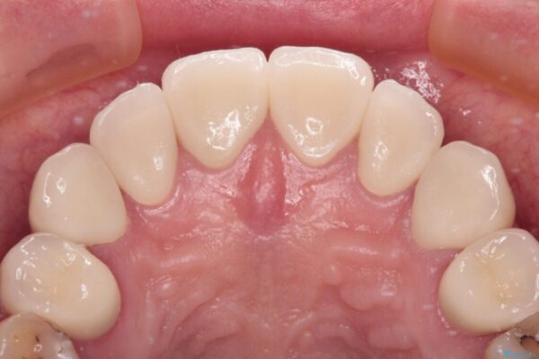 むし歯だらけの前歯をオールセラミッククラウンできれいに 治療後画像