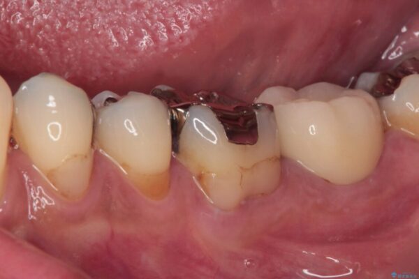 治療をしても違和感の続く奥歯　神経を極力残した虫歯治療 治療後画像