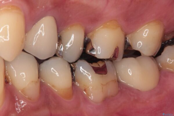 治療をしても違和感の続く奥歯　神経を極力残した虫歯治療 治療後画像
