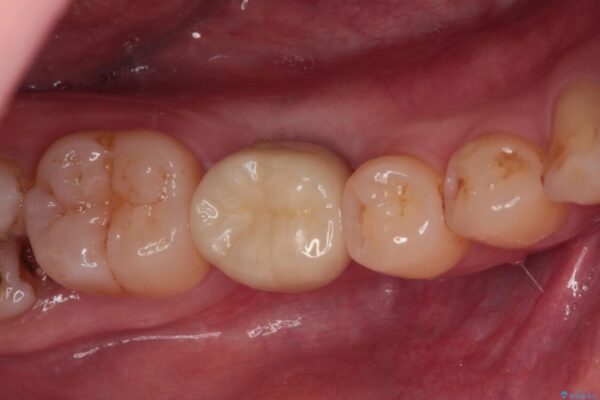 空いている時間を利用して通院　奥歯のインプラント治療 アフター