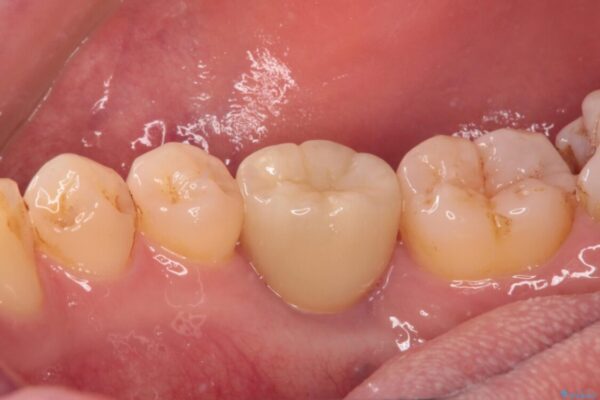 空いている時間を利用して通院　奥歯のインプラント治療 治療後画像