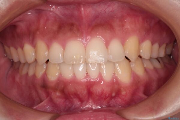 【モニター】カリエール・ディスタライザーを併用した八重歯のインビザライン矯正 アフター