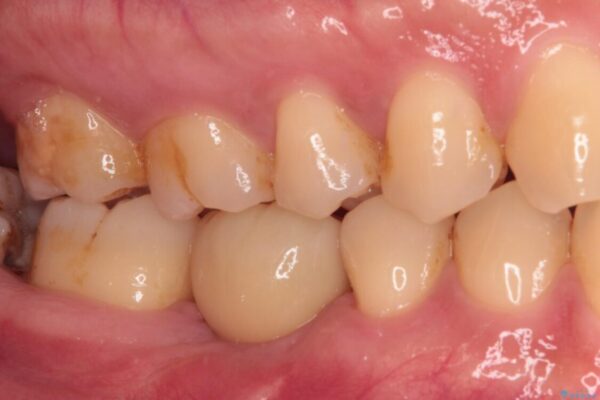 空いている時間を利用して通院　奥歯のインプラント治療 治療後画像