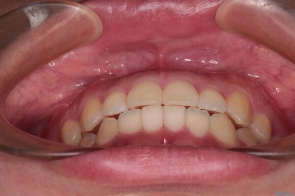 【モニター】カリエール・ディスタライザーを併用した八重歯のインビザライン矯正 治療後画像