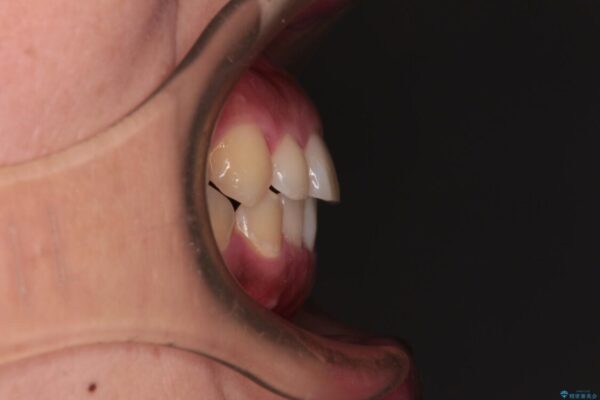 【モニター】カリエール・ディスタライザーを併用した八重歯のインビザライン矯正 治療後画像