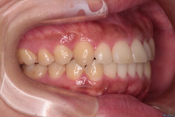 【モニター】カリエール・ディスタライザーを併用した八重歯のインビザライン矯正 治療後画像