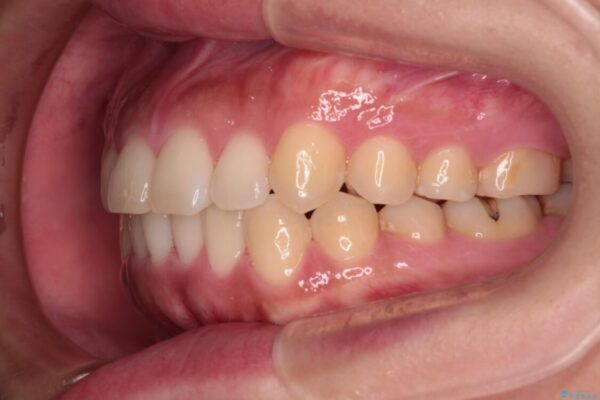 【モニター】カリエール・ディスタライザーを併用した八重歯のインビザライン矯正 治療後画像