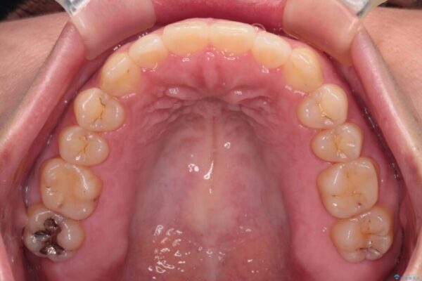 【モニター】カリエール・ディスタライザーを併用した八重歯のインビザライン矯正 治療後画像