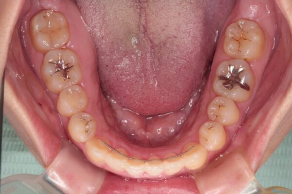 【モニター】カリエール・ディスタライザーを併用した八重歯のインビザライン矯正 治療後画像