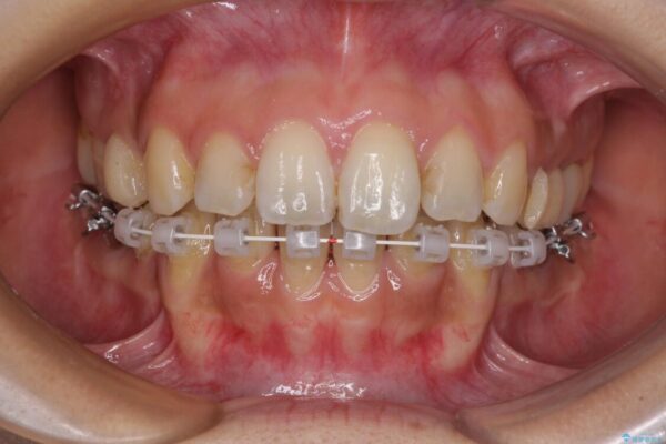 デコボコと口元の突出感　ハーフリンガルでの抜歯矯正 治療途中画像