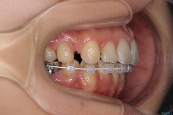 デコボコと口元の突出感　ハーフリンガルでの抜歯矯正 治療途中画像