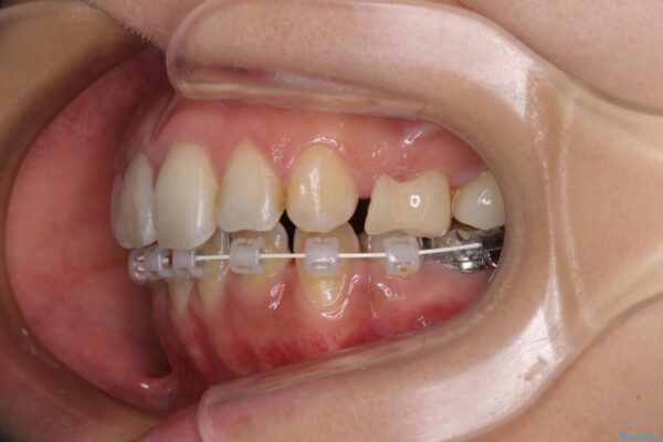 デコボコと口元の突出感　ハーフリンガルでの抜歯矯正 治療途中画像