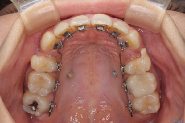 デコボコと口元の突出感　ハーフリンガルでの抜歯矯正 治療途中画像