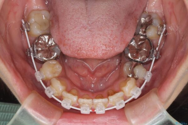 デコボコと口元の突出感　ハーフリンガルでの抜歯矯正 治療途中画像