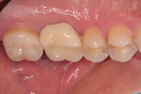 奥歯がズキズキと痛む　奥歯の虫歯治療 治療後画像