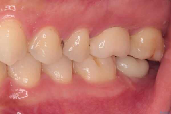 奥歯がズキズキと痛む　奥歯の虫歯治療 治療後画像