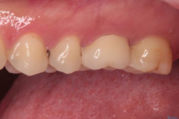 奥歯がズキズキと痛む　奥歯の虫歯治療 治療後画像