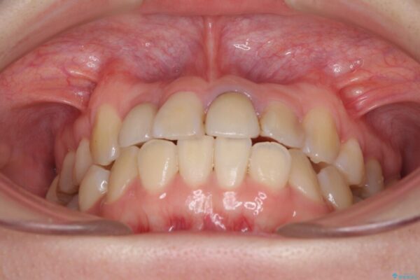 虫歯治療ついでに歯並びの後戻りを改善　インビザラインによる矯正治療 治療前画像