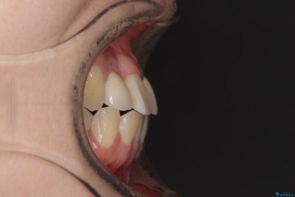 虫歯治療ついでに歯並びの後戻りを改善　インビザラインによる矯正治療 治療前画像