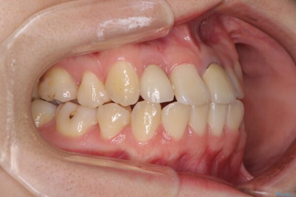 虫歯治療ついでに歯並びの後戻りを改善　インビザラインによる矯正治療 治療前画像