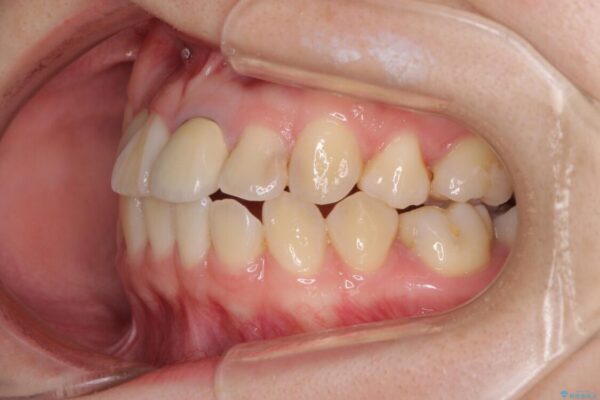 虫歯治療ついでに歯並びの後戻りを改善　インビザラインによる矯正治療 治療前画像