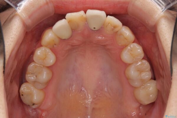 虫歯治療ついでに歯並びの後戻りを改善　インビザラインによる矯正治療 治療前画像