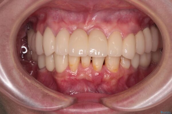 放置したインプラントとインビザライン　全顎リカバリー治療 治療後画像