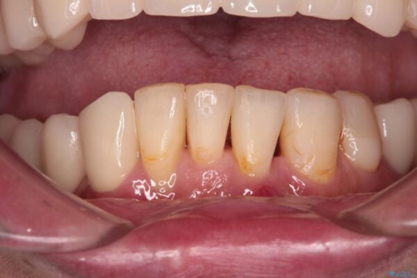 放置したインプラントとインビザライン　全顎リカバリー治療 治療後画像