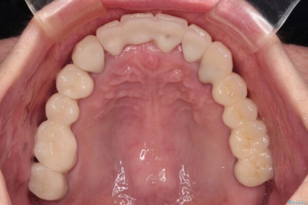 放置したインプラントとインビザライン　全顎リカバリー治療 治療後画像