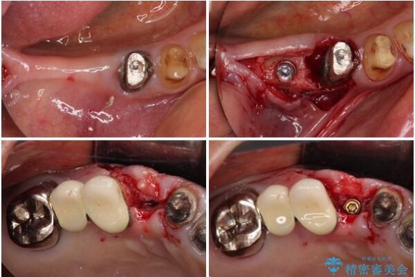 前歯をきれいにしたい　インプラントや部分矯正を用いた総合歯科治療 治療途中画像