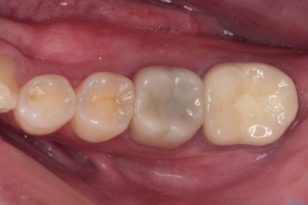 海外赴任前に治したい　割れてしまった奥歯のオールセラミッククラウン 治療後画像