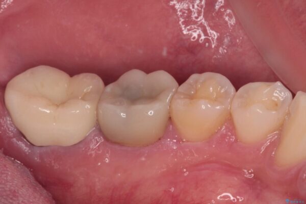 海外赴任前に治したい　割れてしまった奥歯のオールセラミッククラウン 治療後画像