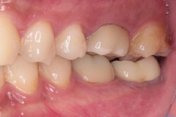 海外赴任前に治したい　割れてしまった奥歯のオールセラミッククラウン 治療後画像